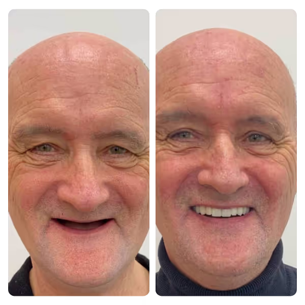 Dental Implants in Turkey